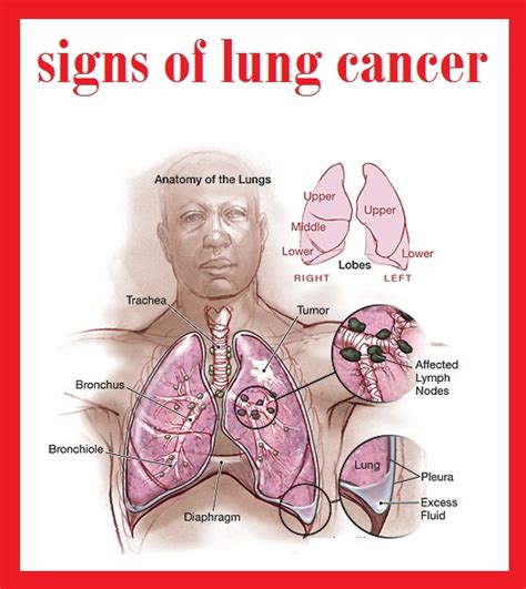 Cancer Spread to Esophagus cell lung bone, and treatment ...