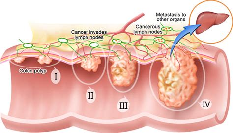 Cancer Types | Colorectal Cancer | Modern Cancer Hospital ...