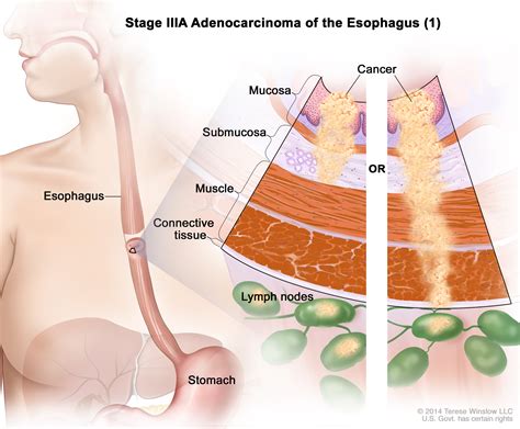 CancerTypes Esophageal Cancer Treatment  PDQ®