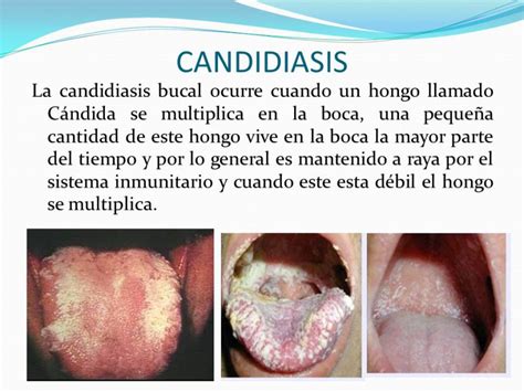 Candidiasis bucal: causas, síntomas y tratamiento