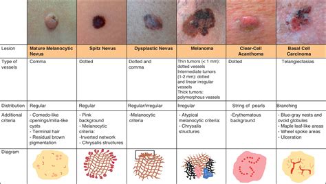 Carcinoma: Basal Cell and Squamous Cell Carcinoma ...