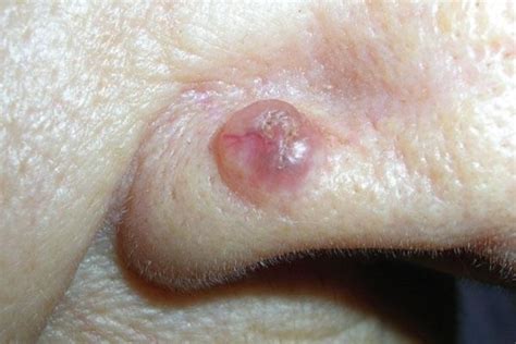 Carcinoma basocelular: o câncer de pele mais comum   Tua Saúde