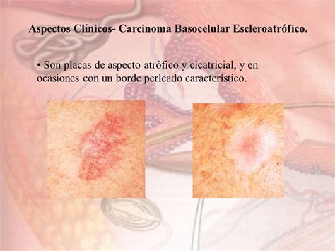 Carcinoma Basocelular   ppt video online descargar
