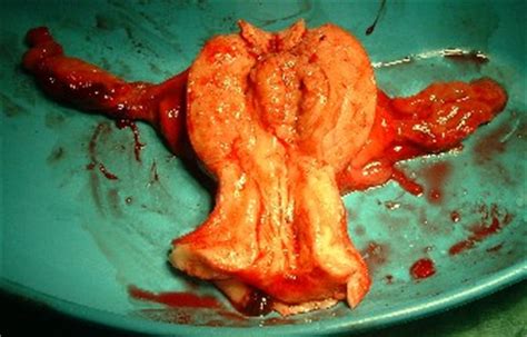 Carcinoma de endometrio   Monografias.com