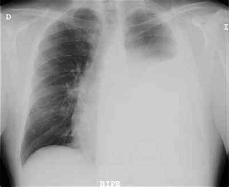 Carcinoma de pulmón no microcítico