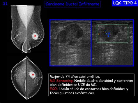 Carcinoma Ductal Infiltrante LQC TIPO 3 29a   ppt descargar
