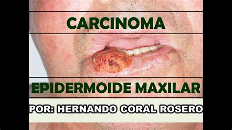 CARCINOMA EPIDERMOIDE MAXILAR   CANCER DE LA PIEL PERIORAL ...