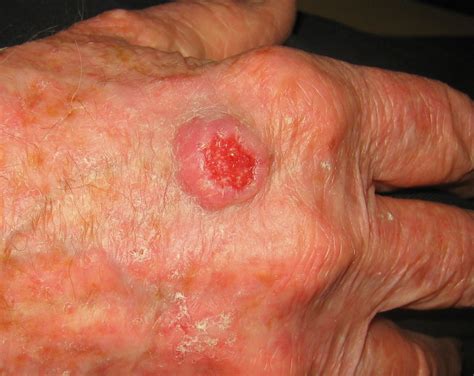 Carcinoma espinocelular de piel – Clinical Sciences