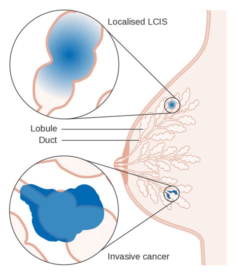Carcinoma lobular in situ – Wikipédia, a enciclopédia livre