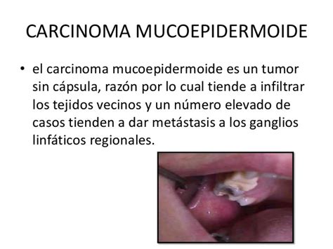 Carcinoma mucoepidermoide
