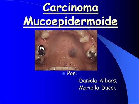 Carcinoma Mucoepidermoide   ppt descargar