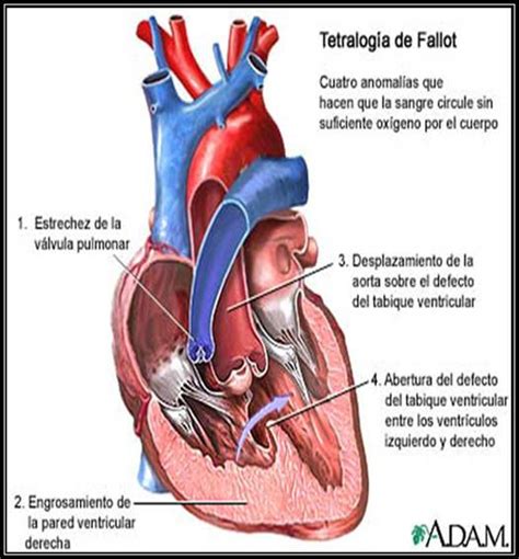 cardiopatias congenitas: cardiopatia congenita