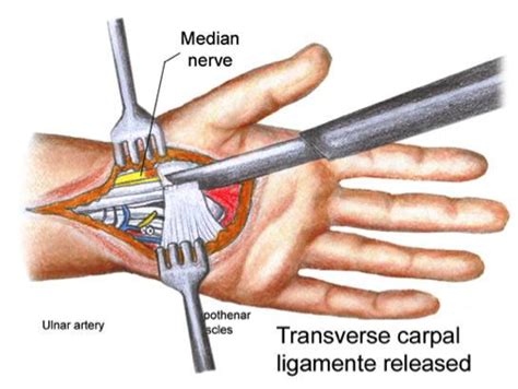 Carpal Tunnel Surgery Video | The Carpal Solution