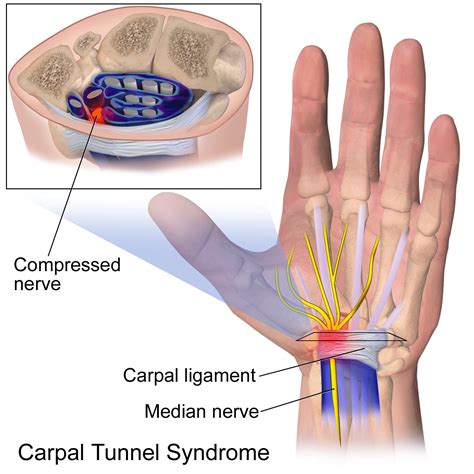 Carpal Tunnel Syndrome Can Be Treated With Chiropractic Care