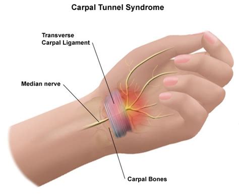 Carpal tunnel syndrome Explanation