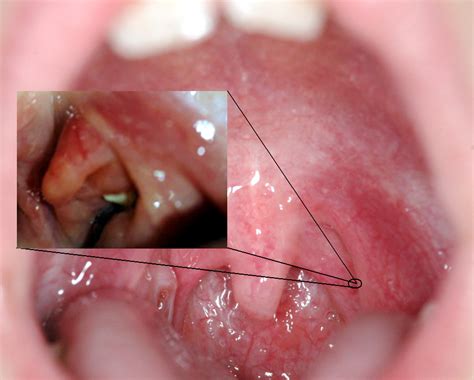 Cáseum | Dr. Carbonell – Otorrinolaringología Pediátrica
