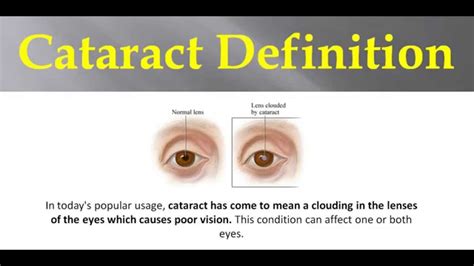 Cataracts Definition   YouTube
