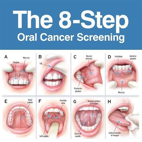 Catching Oral Cancer Early is Key to Survival – Roseman Dental