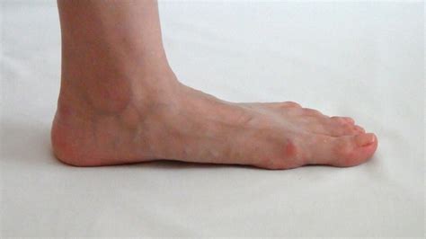 Causas del acido urico en los pies   curacion acido urico ...