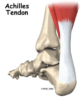 Causes and Treatment of Achilles Tendinopathy | Stone ...
