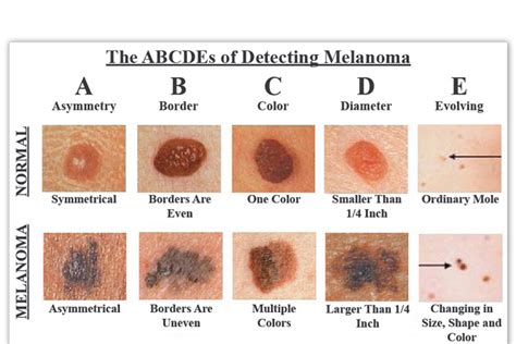causes of skin cancer   DriverLayer Search Engine
