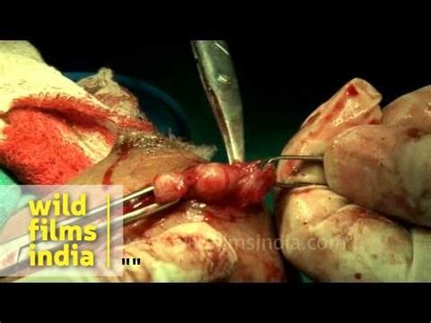 Cavity in the breast after the removal of the cyst ...