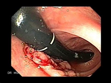 Cecum Cancer and Multiple Polyps of Ascending Colon   YouTube