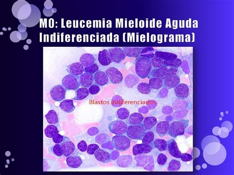 Células Sanguíneas: Leucemias Mieloides Agudas