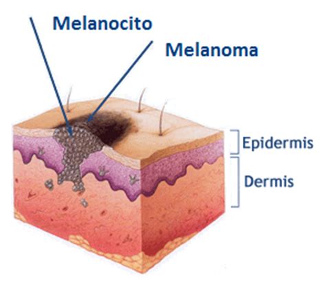 Centro de tratamientos y terapias para melanoma y cancer piel