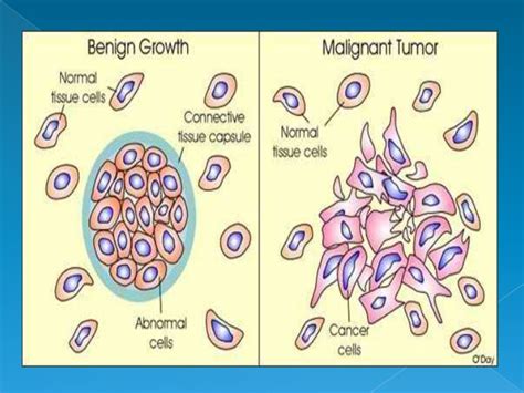 Characteristics of benign and malignant neoplasms