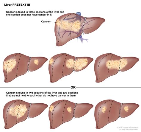 Childhood Liver Cancer Treatment  PDQ® —Patient Version ...