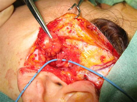 Chirurgia della ghiandola parotide, correzione di cicatrici