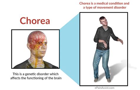 Chorea; Choreatic Disorders; Choreiform Movement