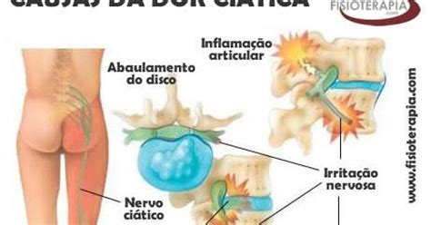 Ciatica Dolor De Rodilla | Ciatica Remedios Caseros