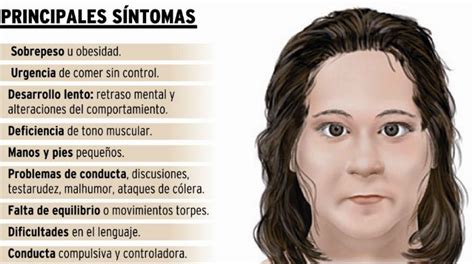 Ciertas características del Síndrome de Angelman ...