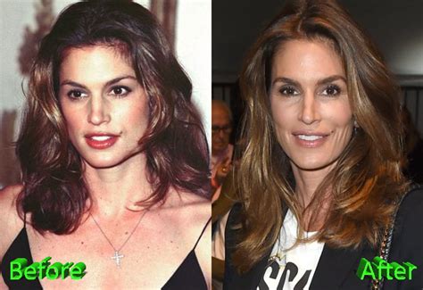 Cindy Crawford Plastic Surgery: Still A Beauty Icon