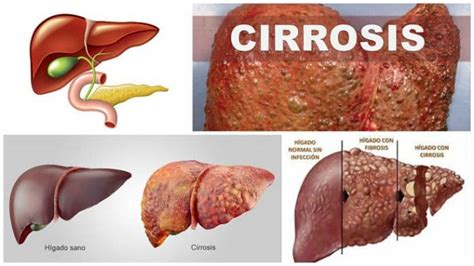 Cirrosis Hepática: Causas, Tipos, Síntomas, Tratamiento y ...