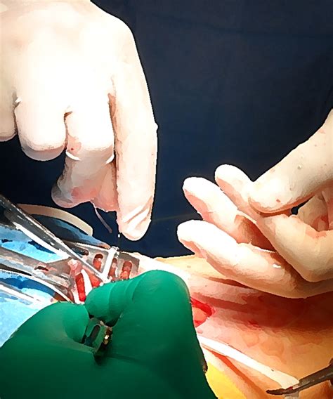 Cirugía Ambulatoria   Atención Vascular : Tratamiento de ...
