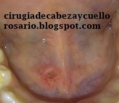 Cirugía de Cabeza y Cuello Rosario: LITIASIS SUBMAXILAR
