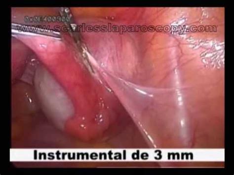 cirugia de ovario sin cicatriz   YouTube