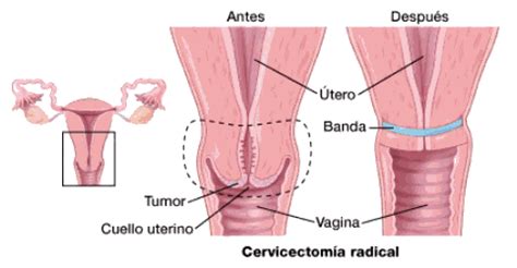 Cirugía para el cáncer de cuello uterino