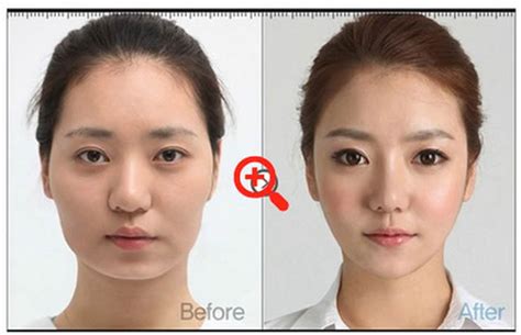 Cirugía plástica en Corea: antes y después   Marcianos