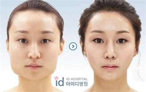 Cirugía plástica en Corea: antes y después   Marcianos