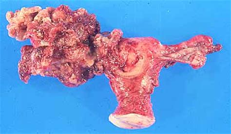 Citometría tumores de ovario. Profª Fariña
