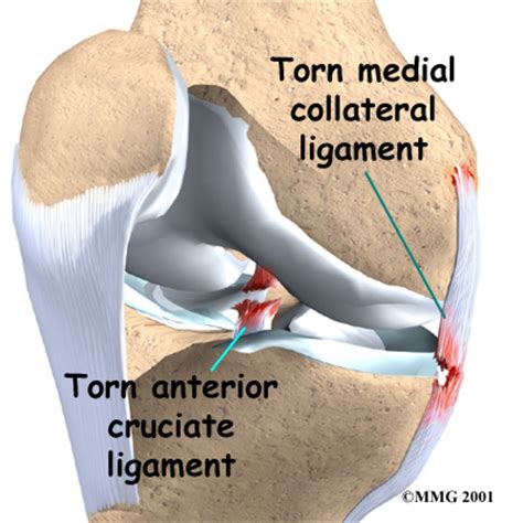 Collateral Ligament Injuries | eOrthopod.com
