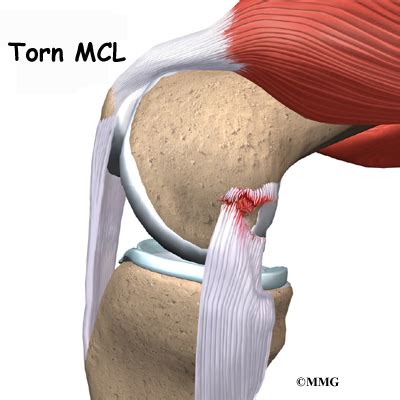 Collateral Ligament Injuries of the Knee | Houston Methodist