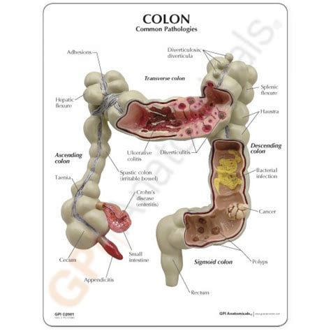 Colon Anatomy Model   Colon Conditions Model 3340