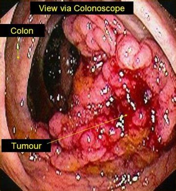 Colon cancer  adenocarcinoma  information | myVMC