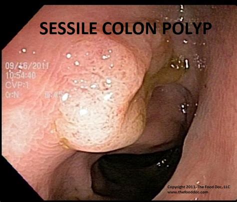 Colon Cancer and Polyps: What You Need to Know ...