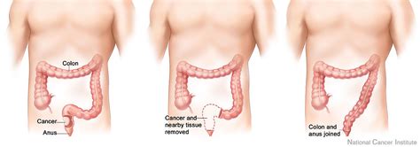 Colon Cancer can be Defeated with Minimally Invasive ...